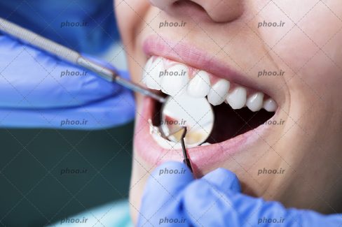 عکس با کیفیت پزشک در حال جرم گیری دندان های زن و دیدن دندان ها به کمک آینه مقعر