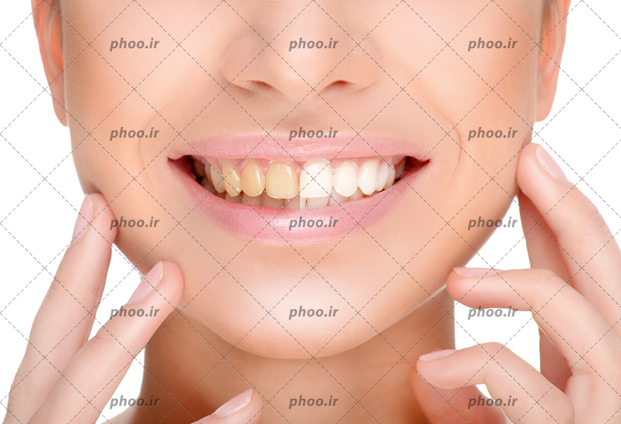 عکس با کیفیت زن با لبخند زیبا و دندان هایی که نیمی از آن ها جرم گیری شده