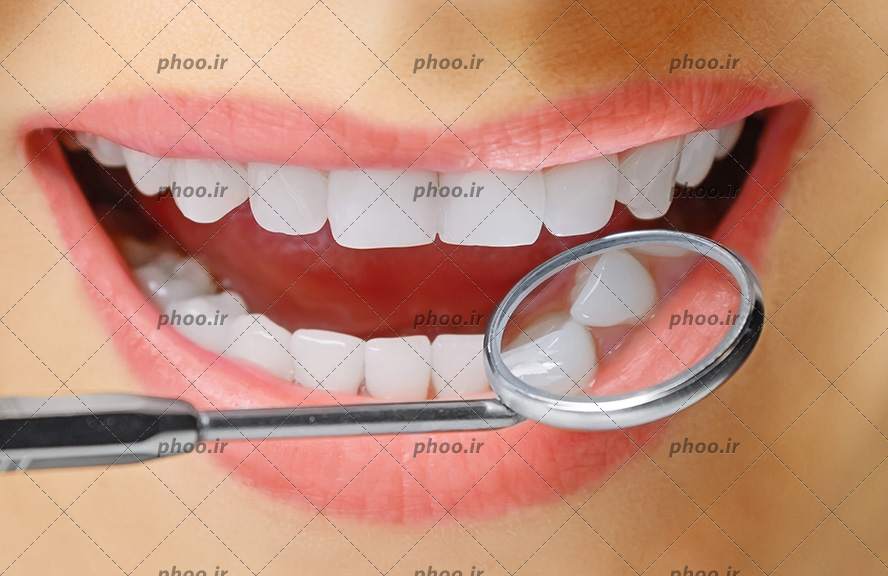 عکس با کیفیت معاینه دندان های سفیدو براق زن با استفاده از آینه مقعر از نمای نزدیک
