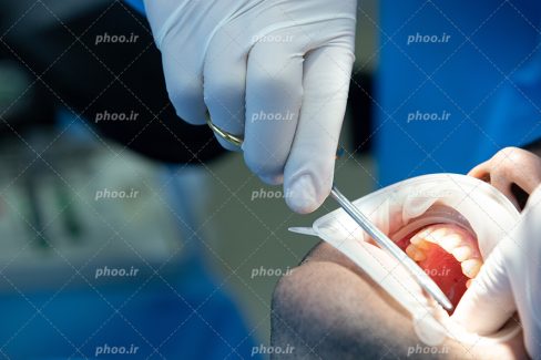 عکس با کیفیت پزشک در حال جرمگیری و بلیچینگ دندان های مرد